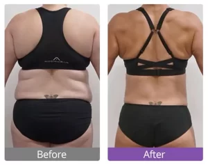 It is a phone revealing the use effect comparison of ultrasonic cavitation machine useful for fat reduction of backs