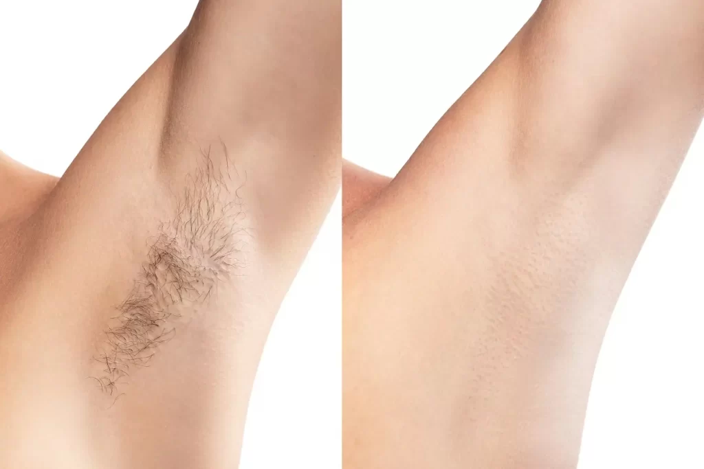 it is a painless laser hair removal before & after photo for permanent hair removal treatment, revealing that  laser hair removal has achieved permanent before&after underarm hair removal result