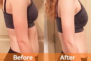 lipo laser rf radio frequency ems muscle stimulator lipo laser before and after 1 treatment does laser lipo work before and after best laser lipo machine 2024