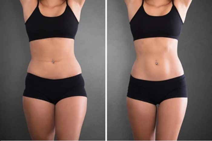 before after photo of emsculpt machine at home for body sculpting